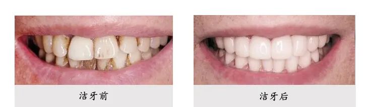 讓口腔清爽、牙齒潔白的利器！最新鬼才設(shè)計(jì)——火爆全球的牙刷！0.18超細(xì)尖毛，25度天鵝頸，牙縫殘?jiān)⑽酃敢粧叨狻? src=