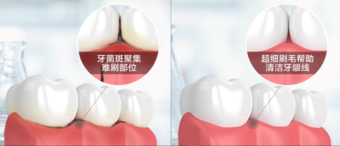 讓口腔清爽、牙齒潔白的利器！最新鬼才設(shè)計(jì)——火爆全球的牙刷！0.18超細(xì)尖毛，25度天鵝頸，牙縫殘?jiān)?、污垢一掃而光? src=